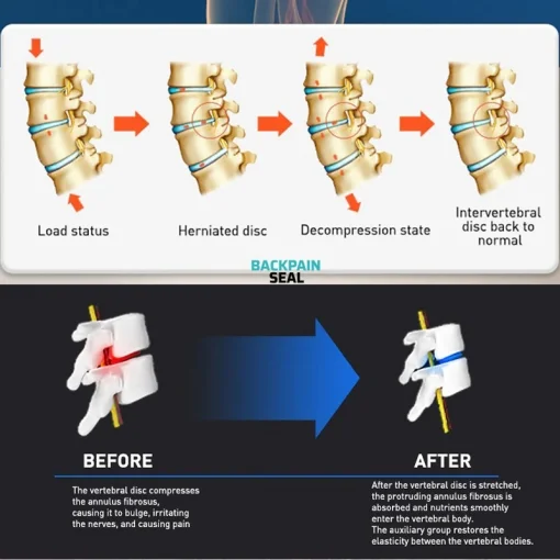 Image showing load status on spine leading to disc herniation. Applying the decompression pressure restores the interverbal disc back to normal